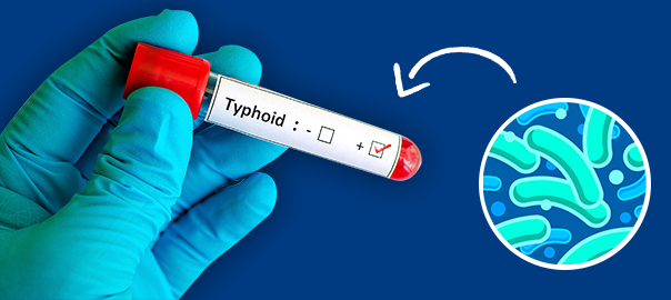 typhoid fever