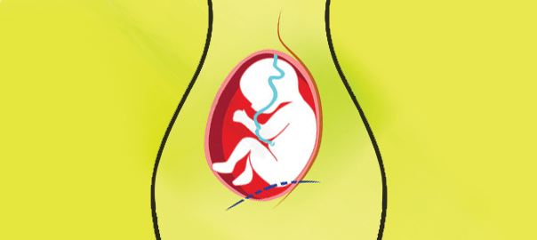 A woman's abdomen showing the C-Section and a baby in her womb