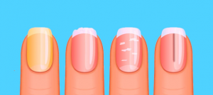 Discolorations_Cracks-or-Lines-on-Nails-blog-featured-image