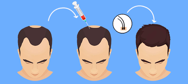 prp injection for hair growth