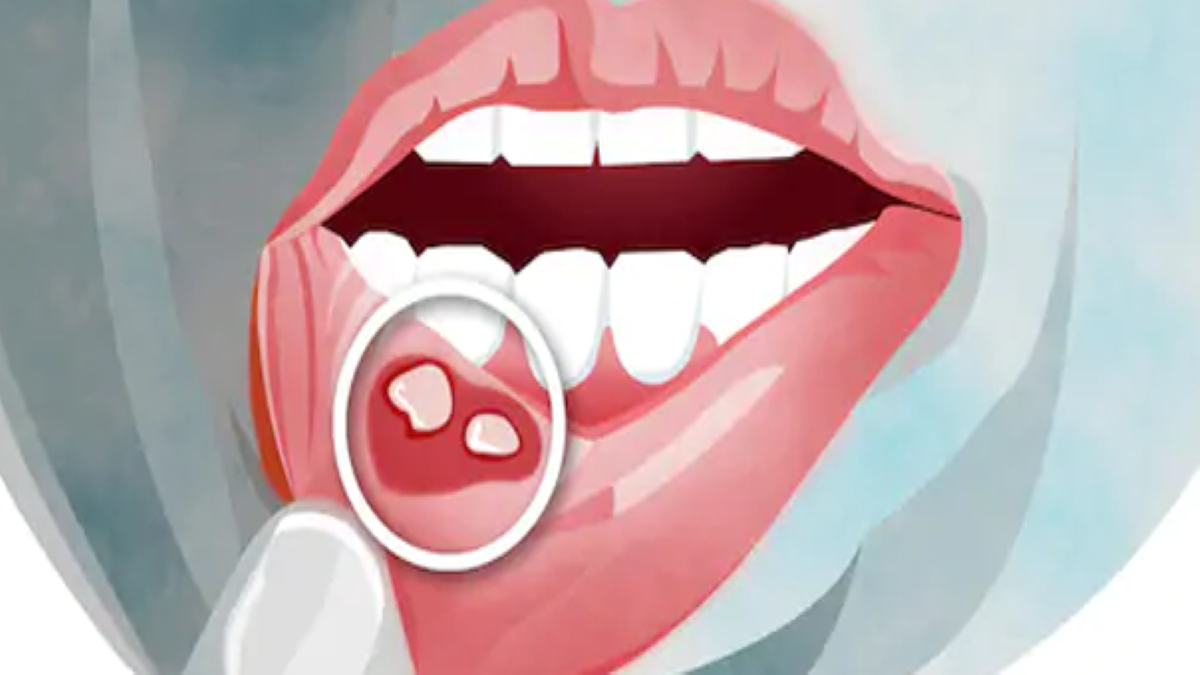 ATTACHMENT DETAILS mouth-ulcers