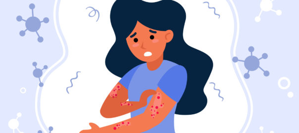 Psoriasis