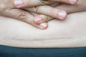 closeup-woman-showing-her-belly-dark-scar-from-سی سیکشن-scaled