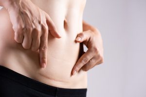 woman-showing-on-her-belly-dark-scar-from-a-cesarean-section-healthcare-